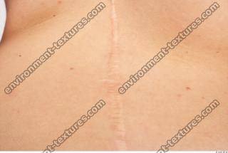 human skin scar 0004